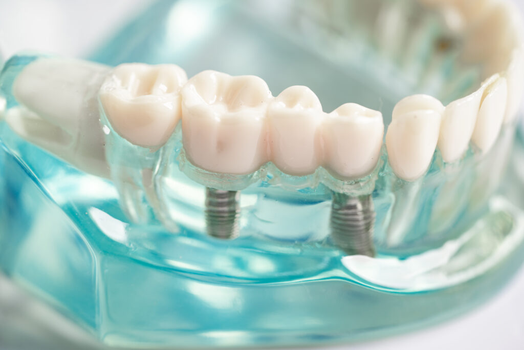 implant-şeffaf-plak-dentangora-ortodonti