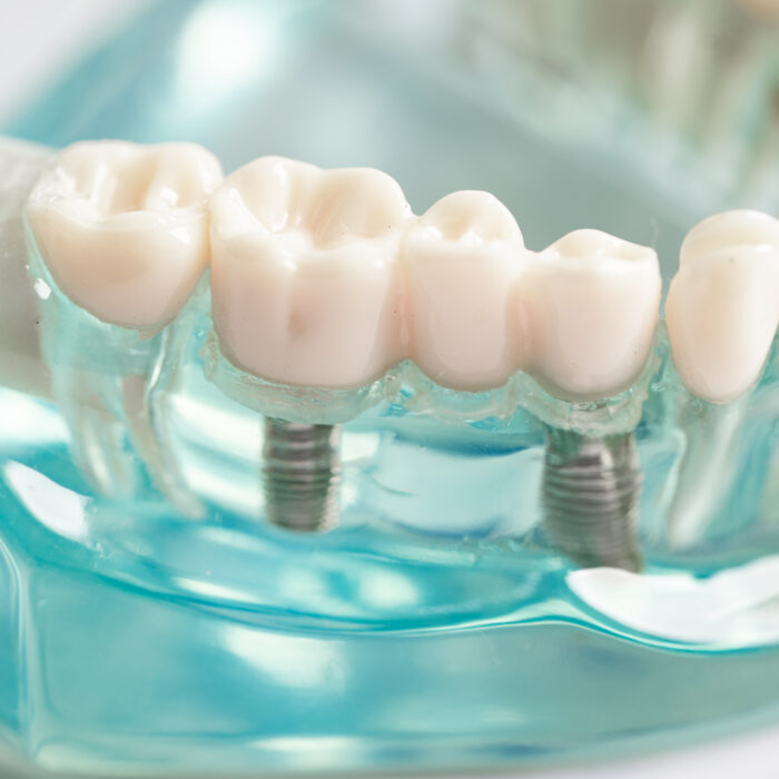 implant-şeffaf-plak-dentangora-ortodonti